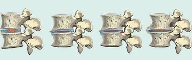 spinal lesion in case of thoracic osteochondrosis