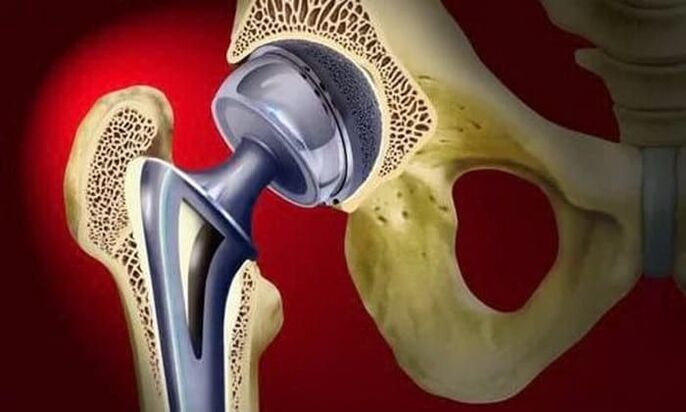 hip joint replacement due to osteoarthritis