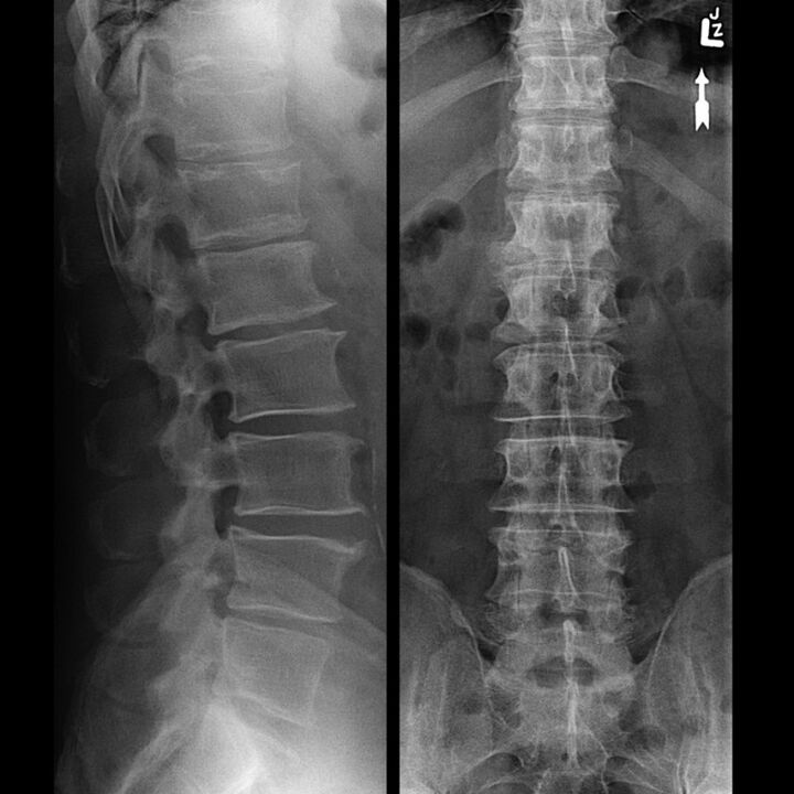 X-ray of the thoracic region, which shows a reduction in the gap between the vertebrae along the spine from the bottom up