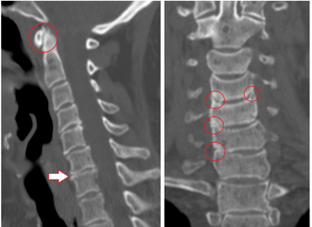 CT shows damaged vertebrae and discs of heterogeneous height due to thoracic osteochondrosis
