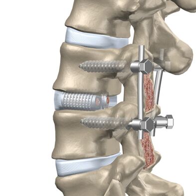 Replacement of the destroyed thoracic spine disc with an artificial implant