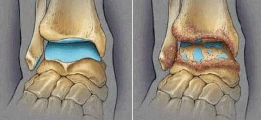 healthy joints and ankle osteoarthritis