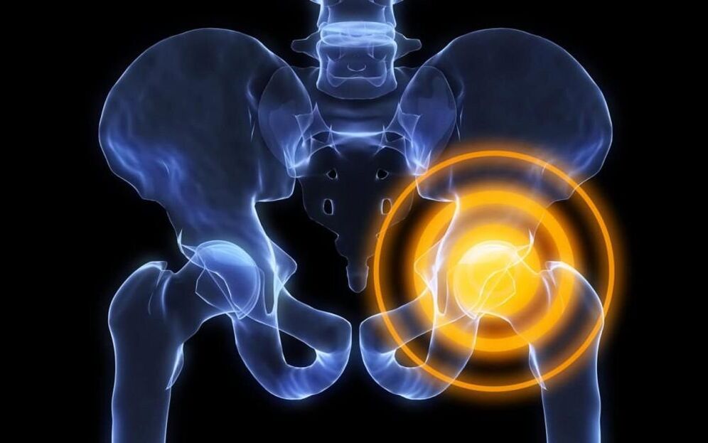 hip joint pain Figure 2