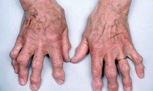 how to distinguish finger arthritis from osteoarthritis
