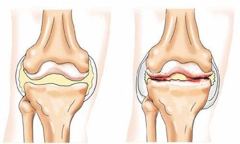 healthy knee joint affected by arthrosis