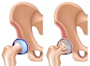 hip arthrosis symptoms