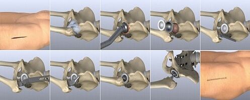 methods of treatment of hip arthrosis